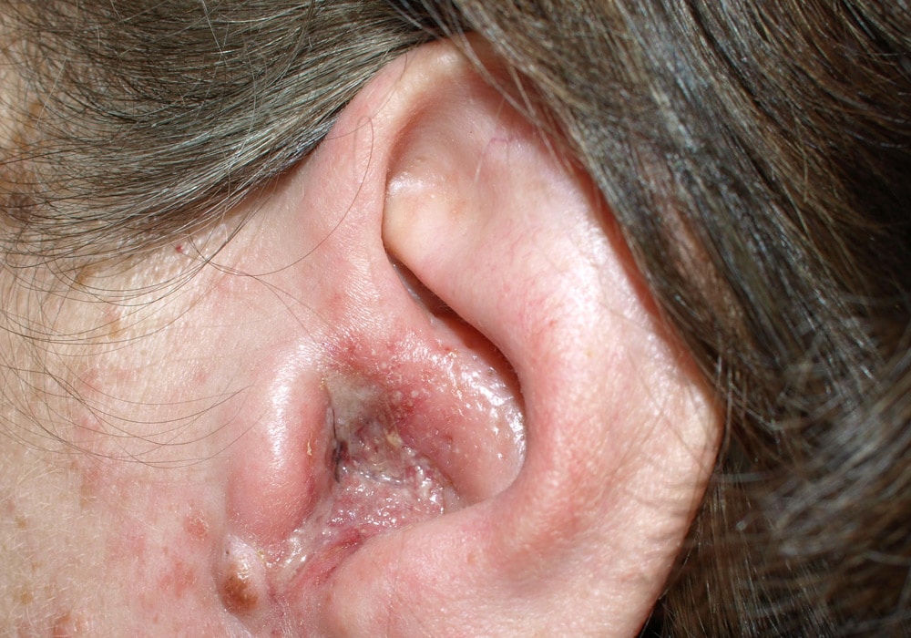 هر آنچه لازم است درباره التهاب گوش بدانید - موسسه دانش بنیان نیوشا